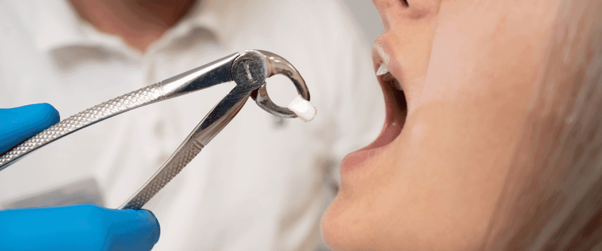 Teeth extraction care at Smile Lounge