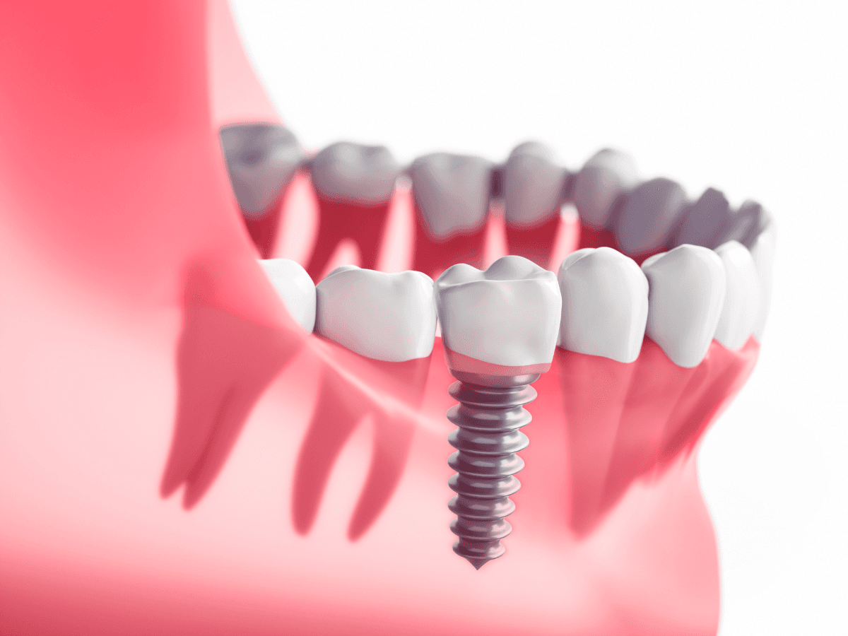 Dental implants at Smile Lounge Dentistry in Milton