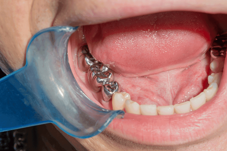 Restorative dentistry at Smile Lounge Dentistry in Milton