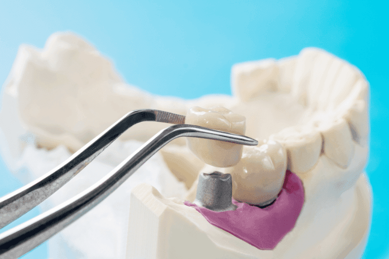 Restorative dentistry at Smile Lounge Dentistry in Milton