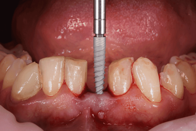 Restorative dentistry at Smile Lounge Dentistry in Milton
