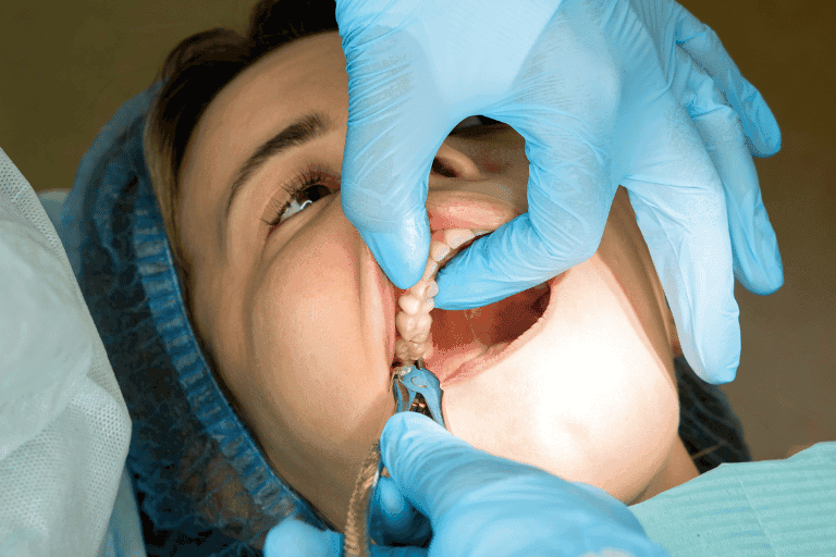 Teeth extraction at Smile Lounge Dentistry in Milton