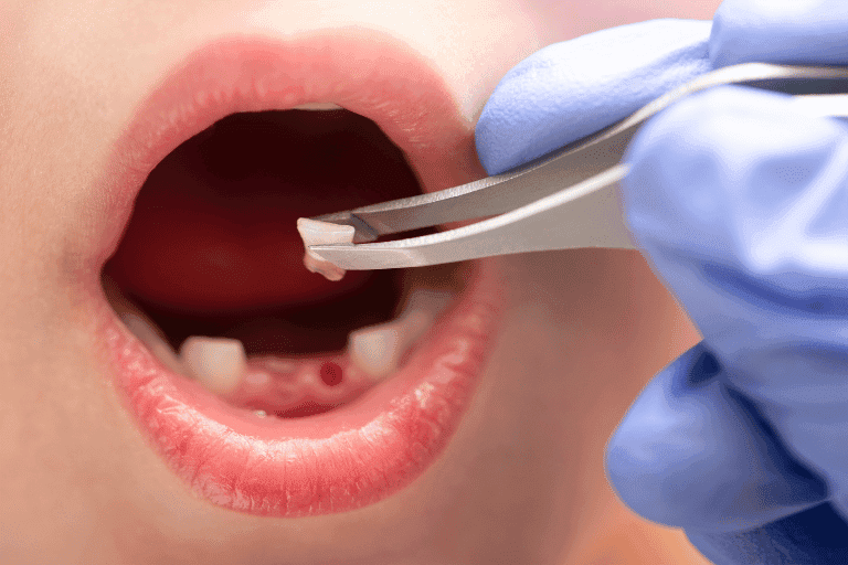 Teeth extraction at Smile Lounge Dentistry in Milton