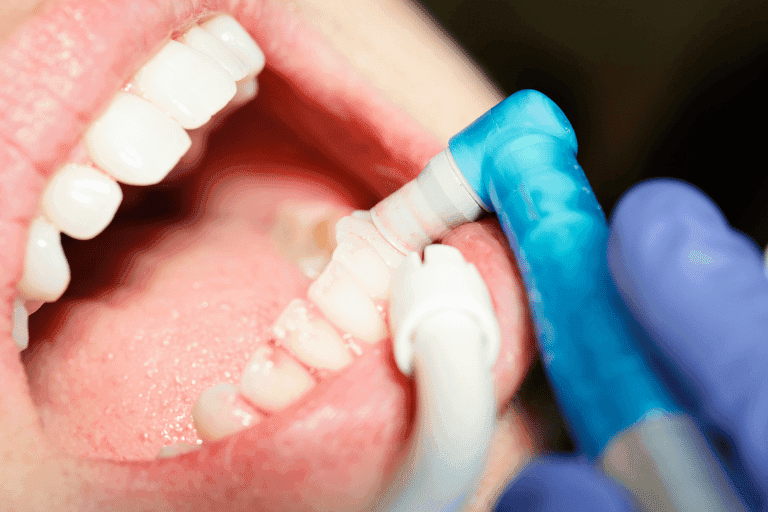 Dental cleaning procedure at Smile Lounge