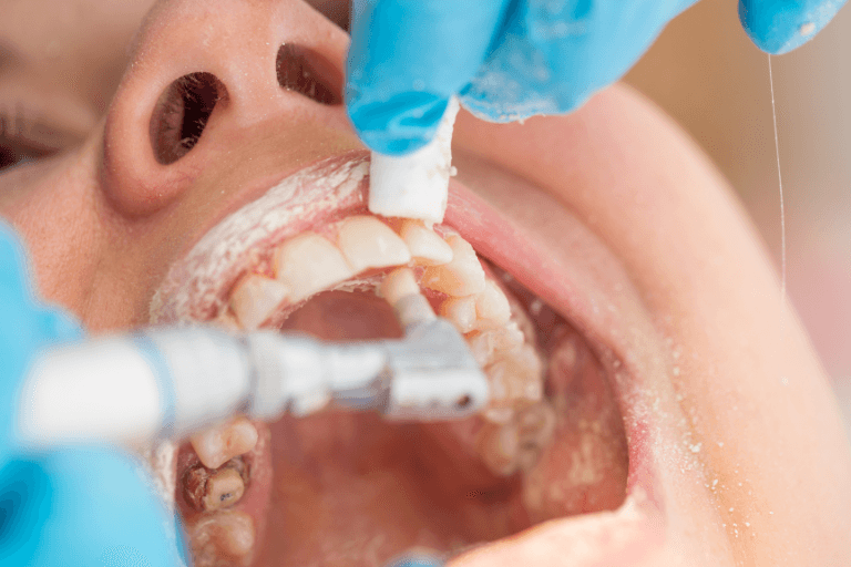 Dental cleaning procedure at Smile Lounge