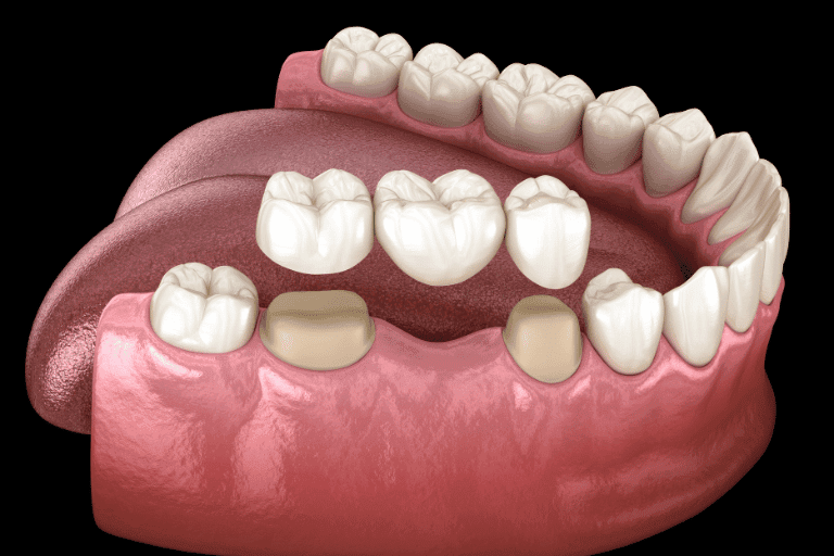 Dental Bridges at Smile Lounge