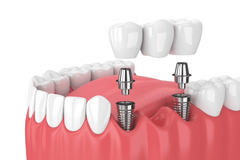 Dental Bridges at Smile Lounge