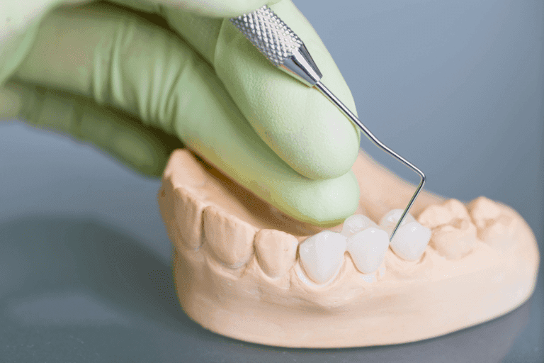 Dental Bridges at Smile Lounge
