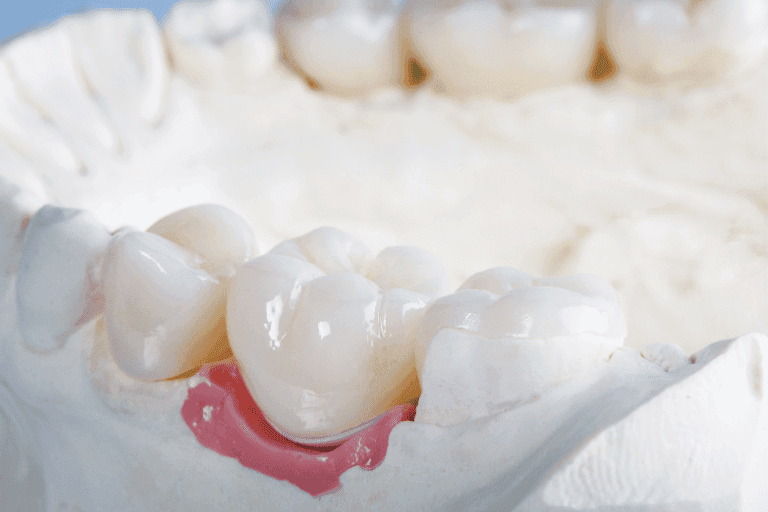 Dental Crowns at Smile Lounge