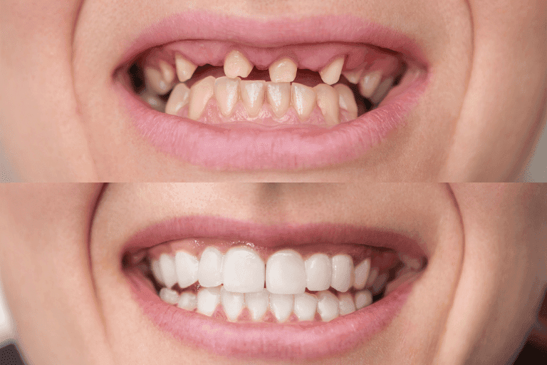Dental Crowns at Smile Lounge