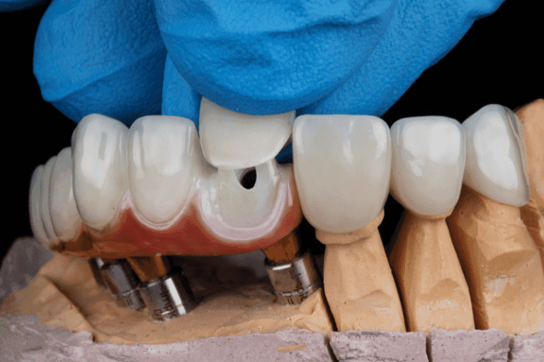 Dental Crowns at Smile Lounge
