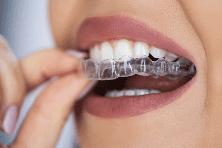 Dental Mouth Guards at Smile Lounge