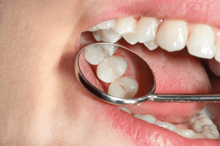 Dental Sealents at Smile Lounge