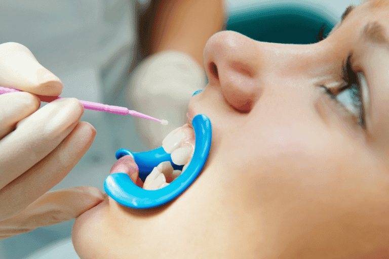 Dental Sealents at Smile Lounge