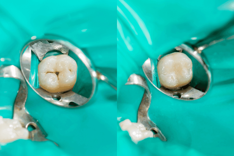Dental Sealents at Smile Lounge