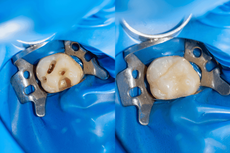Dental Sealents at Smile Lounge