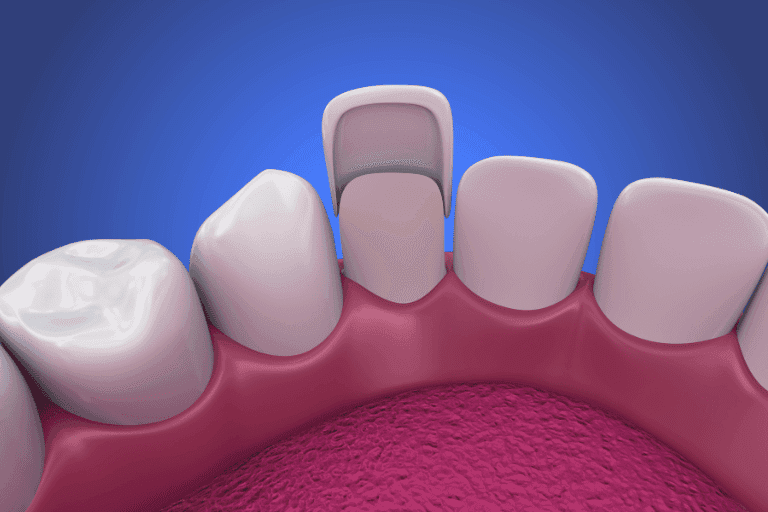 Dental Veneers at Smile Lounge