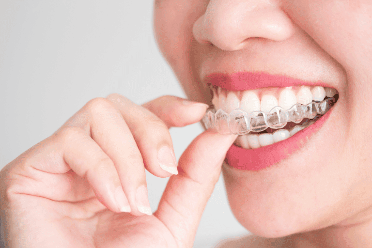 Invisalign at Smile Lounge