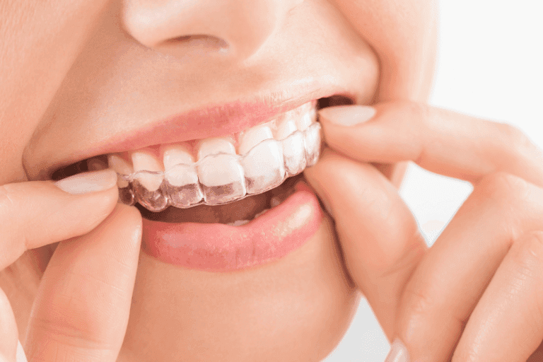 Invisalign at Smile Lounge