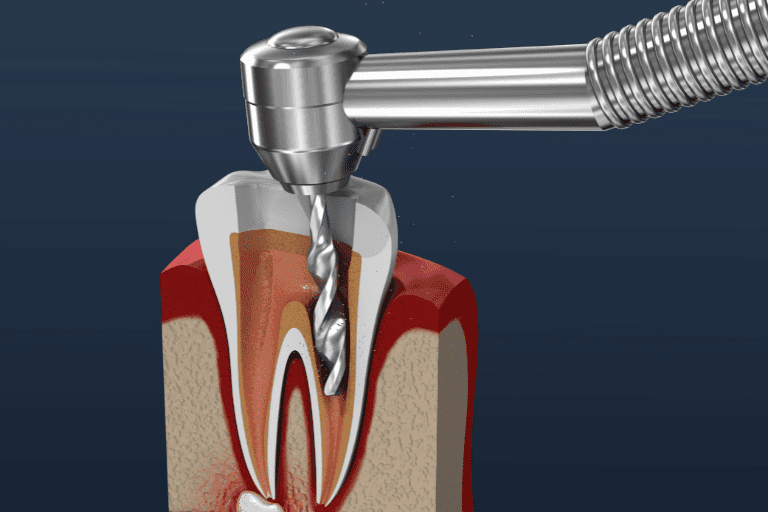 Root Canal Treatment at Smile Lounge