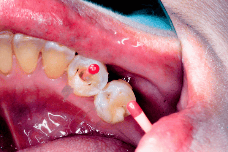 Root Canal Treatment at Smile Lounge