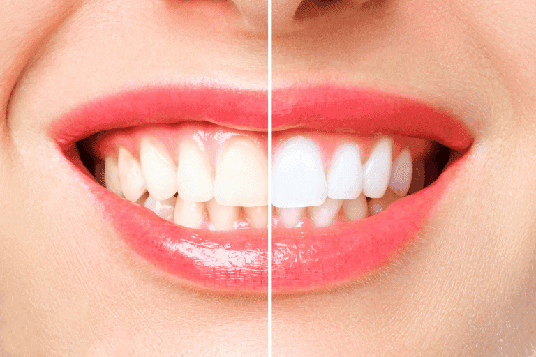 Teeth Whitening at Smile Lounge