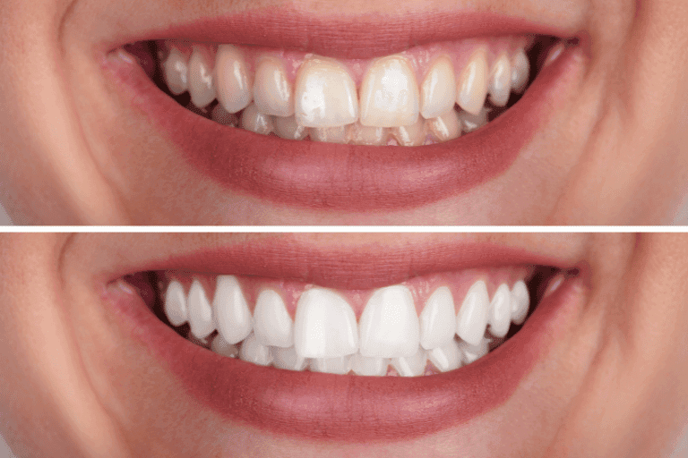 Teeth Whitening at Smile Lounge