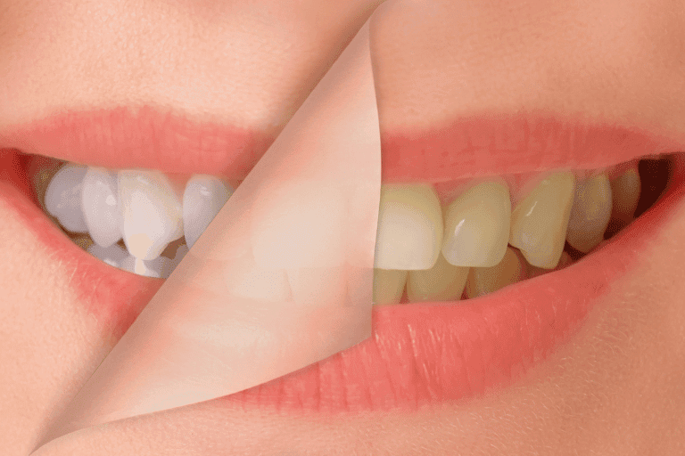Teeth Whitening at Smile Lounge