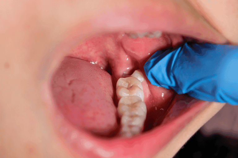 Wisdom Teeth Extraction at Smile Lounge
