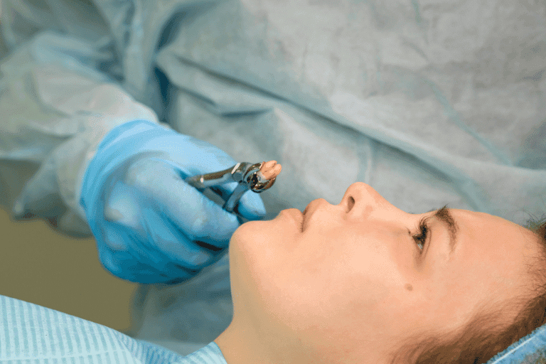 Wisdom Teeth Extraction at Smile Lounge