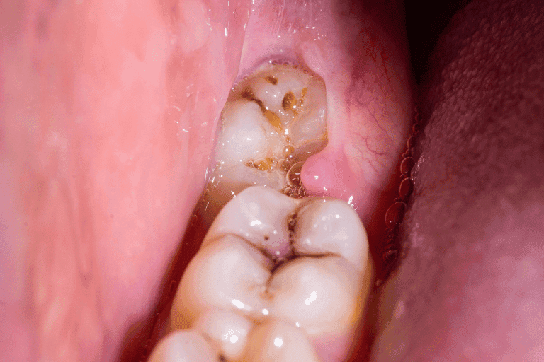 Wisdom Teeth Extraction at Smile Lounge